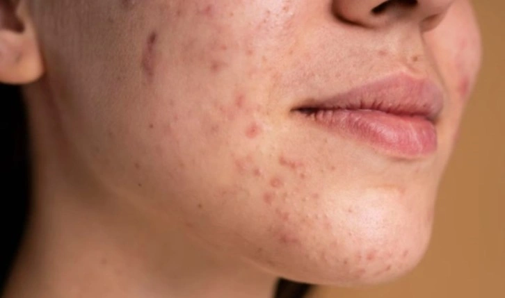 Dermatologlara göre sivilce izlerini geçirmek için yapmanız gereken her şey...