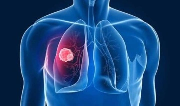 Akciğer kanserinde ömrü uzatan tedavi yöntemi: Akıllı ilaç